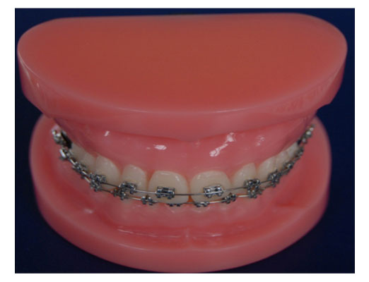 牙齒固定矯正模型