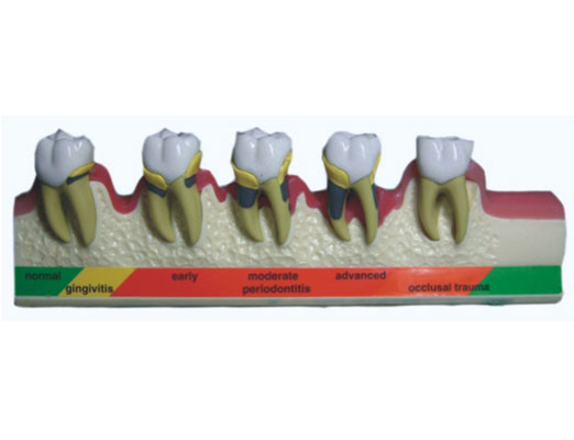 牙周病分類模型